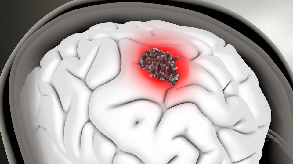 Traiter Le Cancer Du Cerveau Avec Le Virus De La Polio Radio Canada Ca