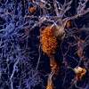 Illustration montrant des neurones sains (à gauche) et des neurones présentant des plaques amyloïdes. 