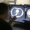 Un radiologiste analyse l'image d'un nodule sur un scan du poumon d'un fumeur.