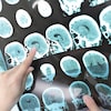 Images du cerveau d'un patient atteint de sclérose en plaques.