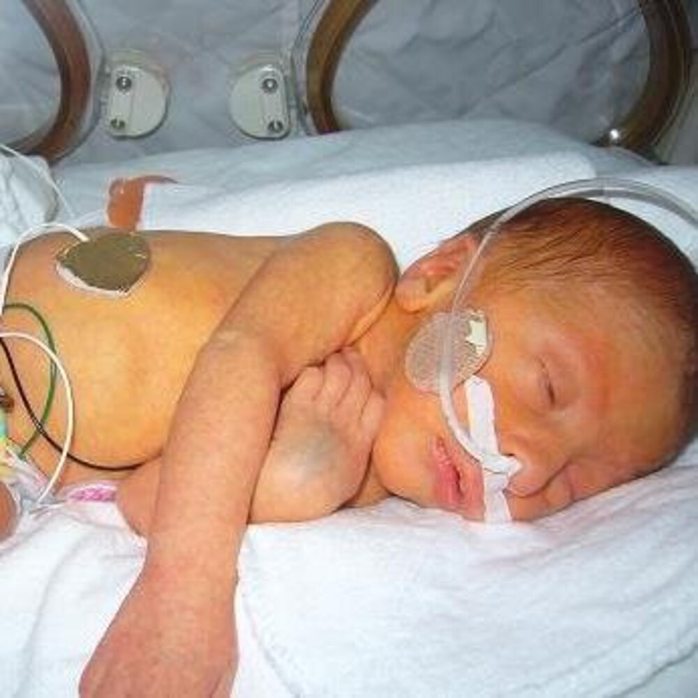 Simon Lavoie, bébé, dans un incubateur.