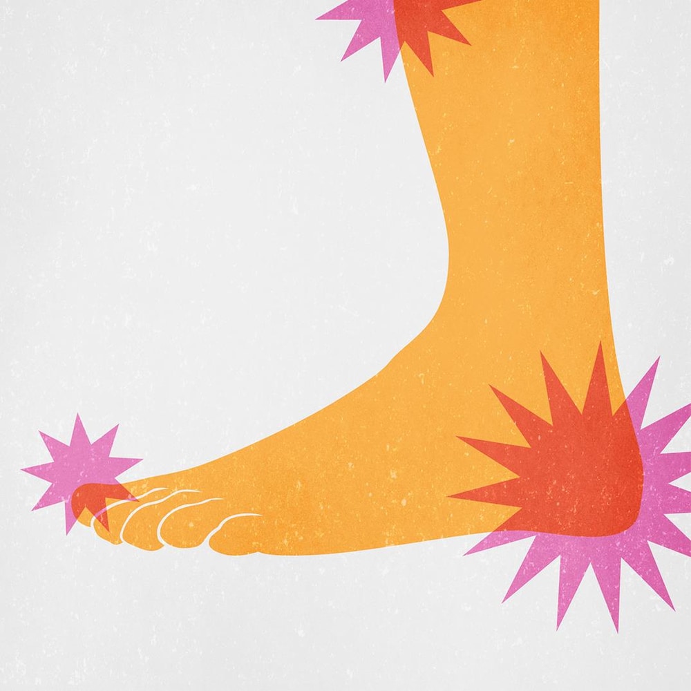 Illustration d'une silhouette de pied de couleur jaune, avec des étoiles roses reprsentants des zones douloureuses, des blessures sous-cutanées.