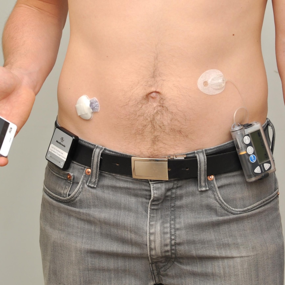 Le ventre d'un homme avec des appareils lui permettant de surveiller son taux de glycémie sur son téléphone intelligent.