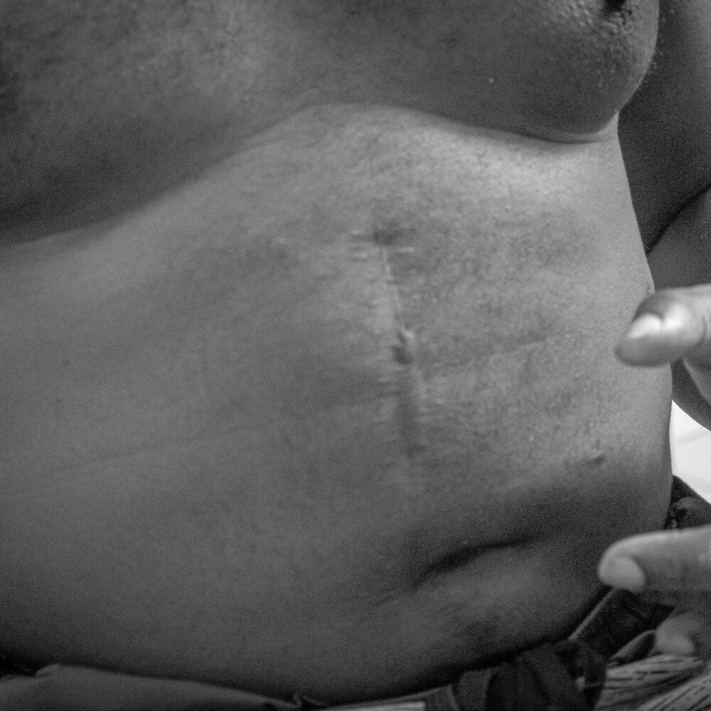 Une cicatrice sur le ventre d'un homme.