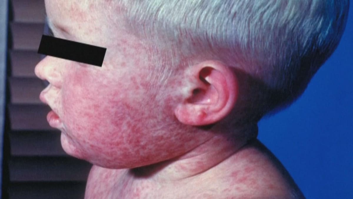 Un jeune enfant atteint de la rougeole est couvert de plaques rouges. 