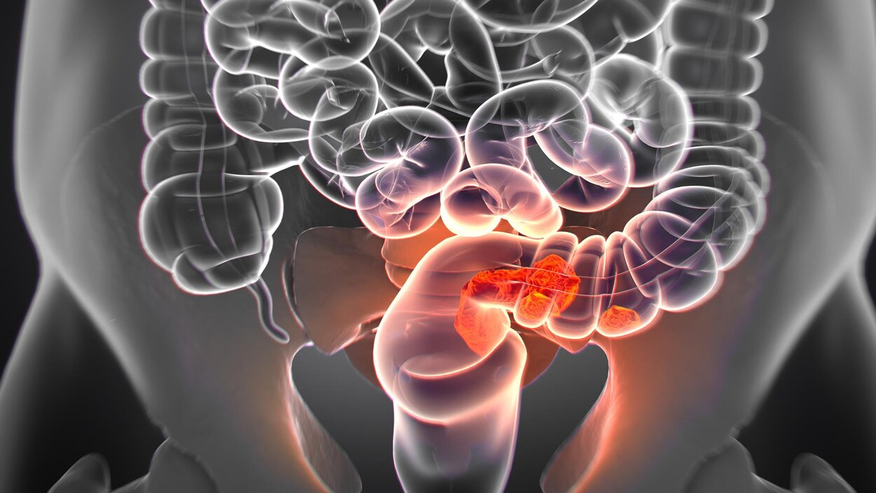 Le Cancer Colorectal Est En Progression Chez Les Plus Jeunes Radio Canada Ca
