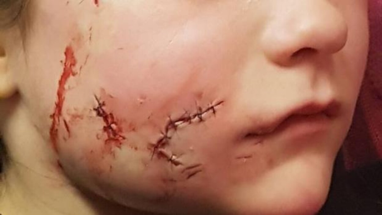 Blessée Au Visage Par Un Chien Morsures Ou Griffes Les