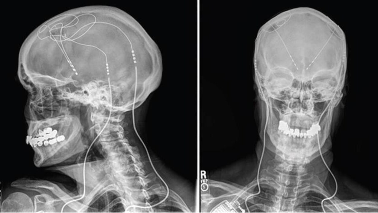 Radiographie montrant le stimulateur dans le cerveau d'une patiente.
