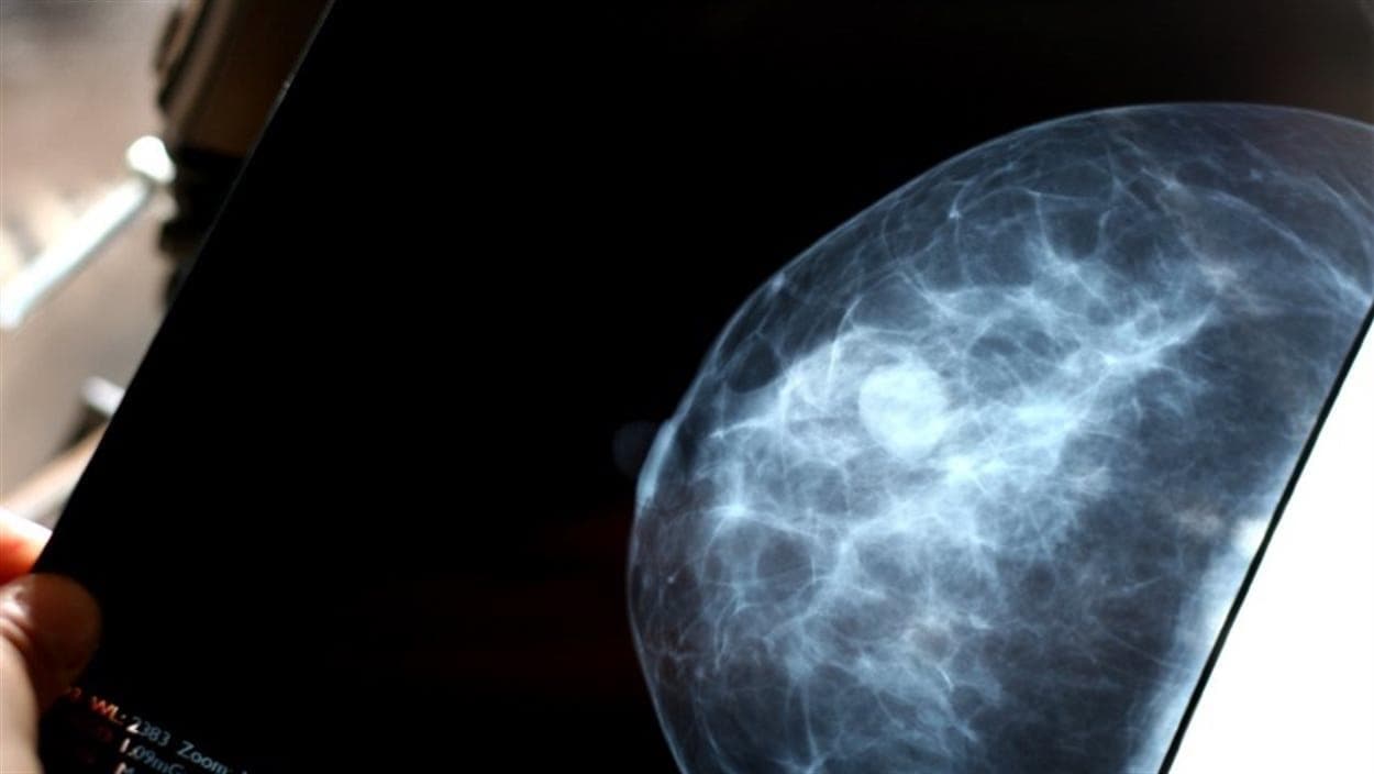Une mammographie. Une mammographie.