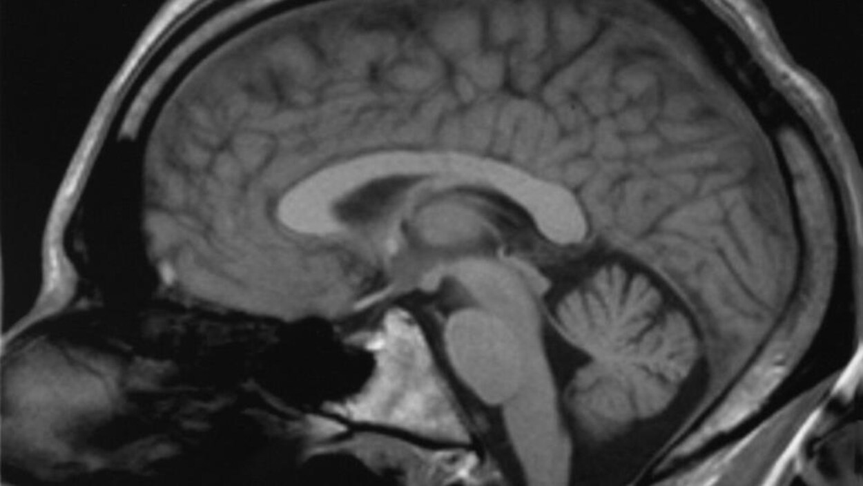Le cortex cingulaire d’un cerveau humain, tel qu’illustré grâce à une imagerie par résonance magnétique Le cortex cingulaire d’un cerveau humain, tel qu’illustré grâce à une imagerie par résonance magnétique