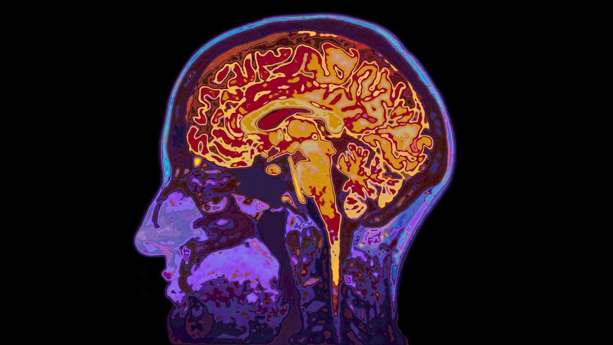 Le glucose à nouveau associé à un vieillissement prématuré du cerveau