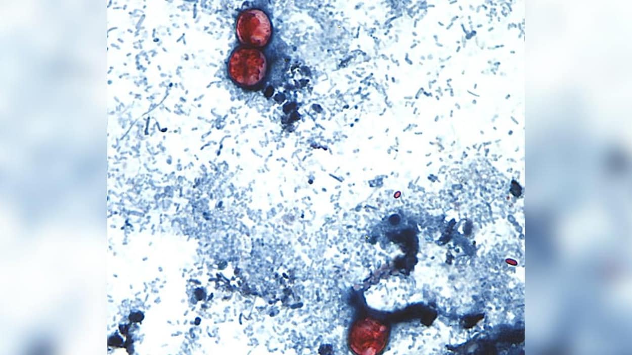 Six cas d’une maladie intestinale détectés en Alberta
