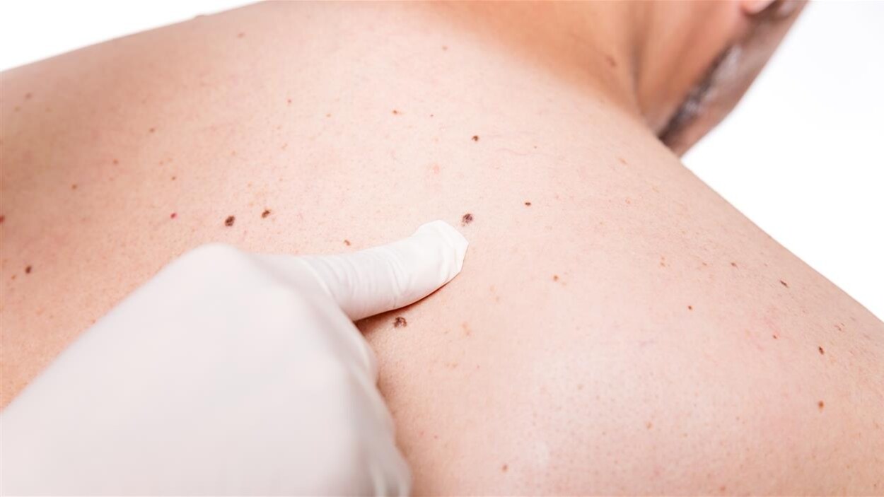 Un ou une médecin examine les grains de beauté d'un homme Un ou une médecin examine les grains de beauté d'un homme