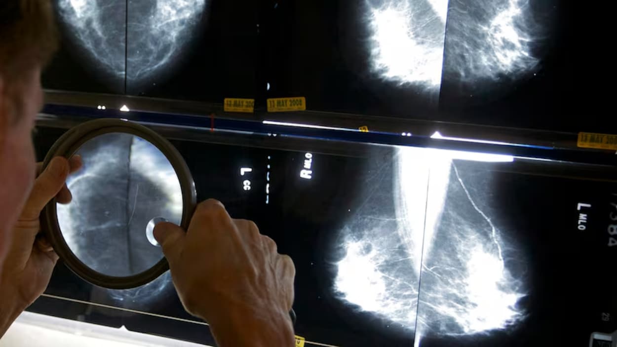 Des lacunes dans la prise en charge des femmes noires atteintes de cancer