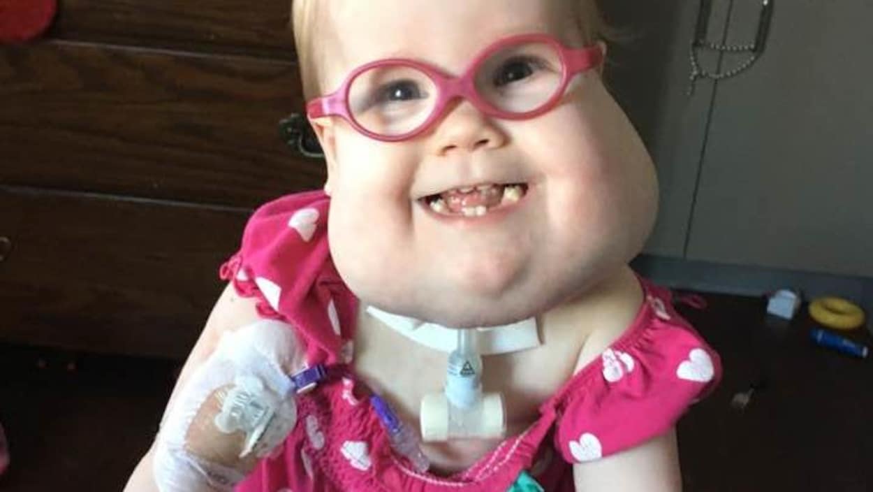 Une fillette souffrant d'une rare malformation rentre chez elle pour la