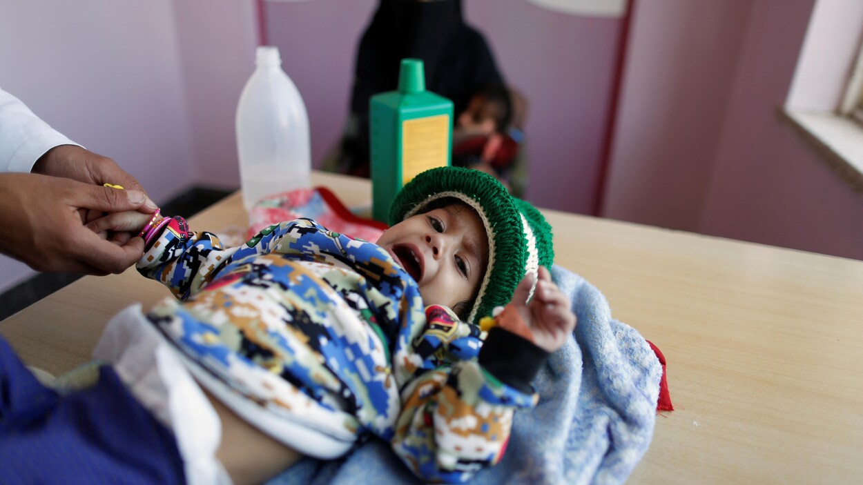 Un enfant traité pour malnutrition à Sanaa Un enfant traité pour malnutrition à Sanaa