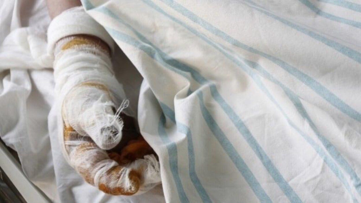 Un patient alité a une main brûlée par des engelures et enveloppée dans un bandage.