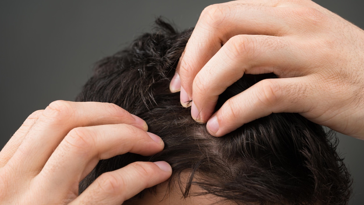 Les raisons de la perte de cheveux chez les enfants et ce qu'il faut faire  pour y remédier