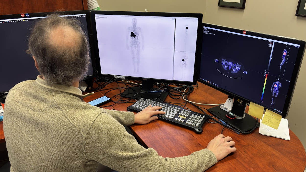 De l’espoir pour détecter la SLA plus tôt