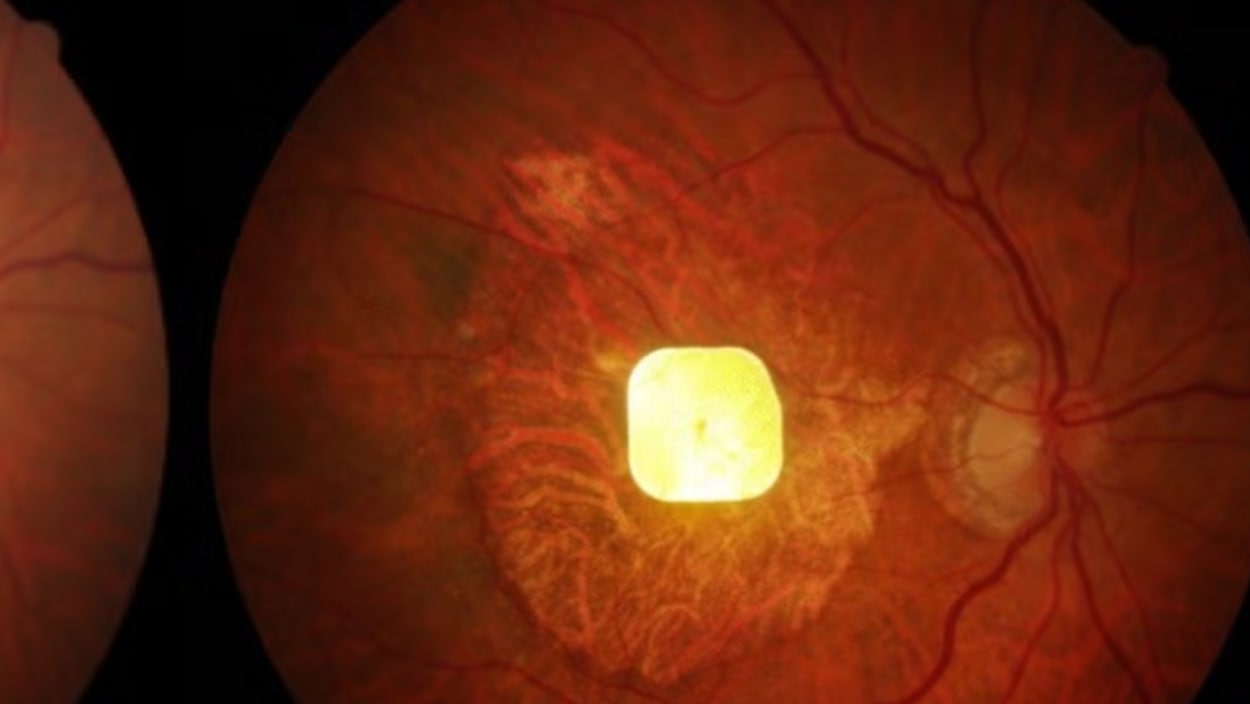 Des patients atteints de dégénérescence maculaire liée à l’âge retrouvent la vue