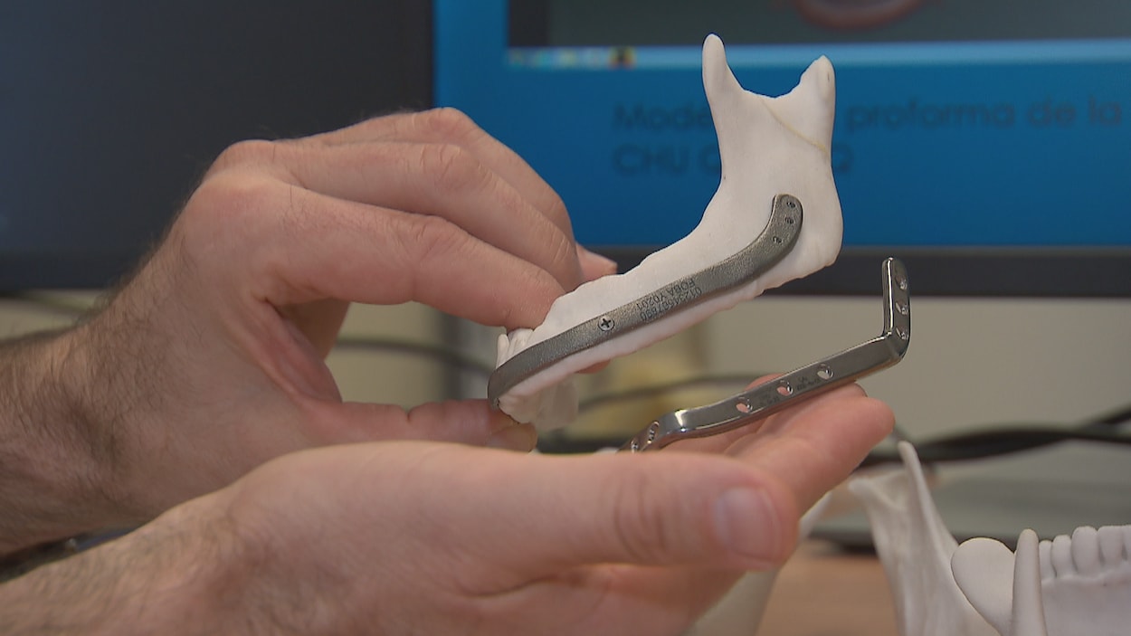 Un exemple de barre mandibulaire imprimée développée dans le laboratoire de reconstruction anatomique.