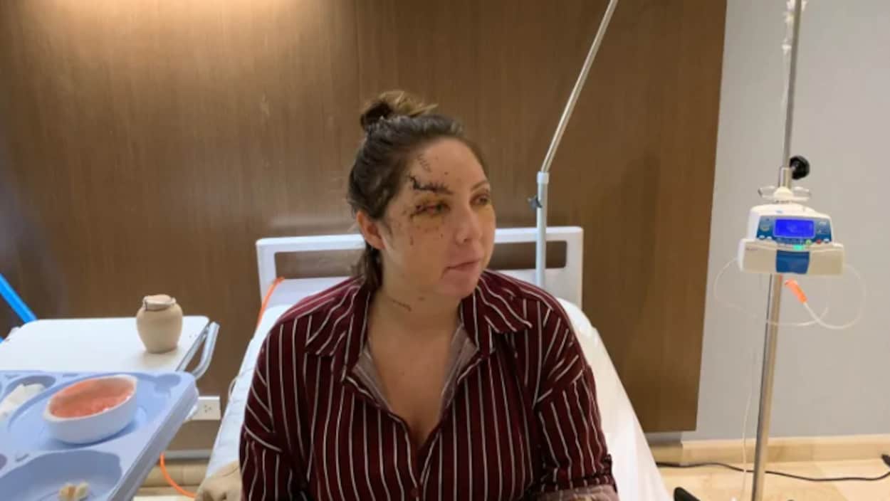 Une femme blessée au visage sur un lit d'hôpital