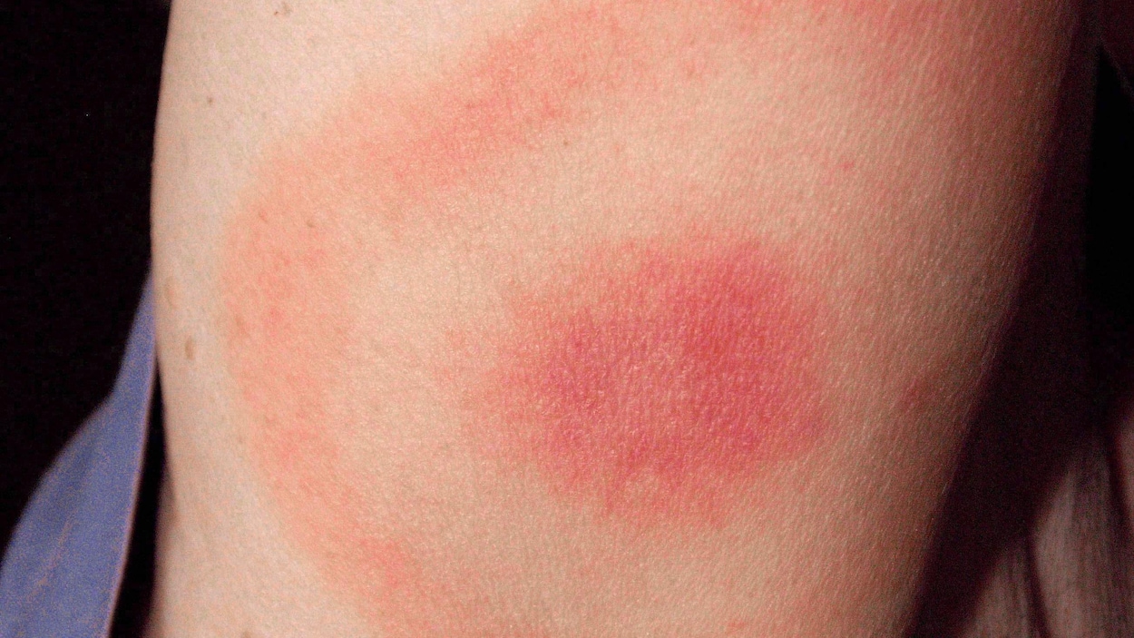 Rougeur typique de celle causée par une morsure de tique infectée par une bactérie, sur l’avant-bras d’une femme du Maryland qui a par la suite développé la maladie de Lyme
