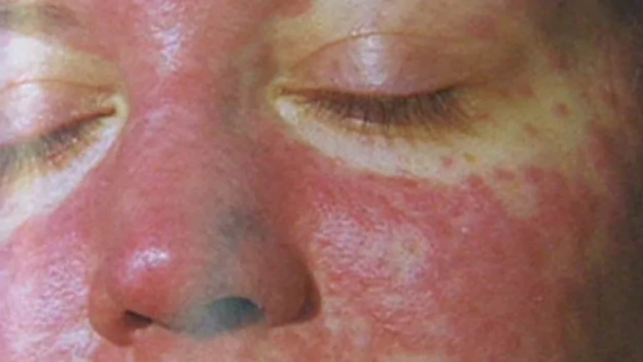 La rougeole est l'une des maladies les plus contagieuses. Le virus se propage le plus souvent au début de la maladie ou avant que les personnes sachent qu'elles ont la rougeole.