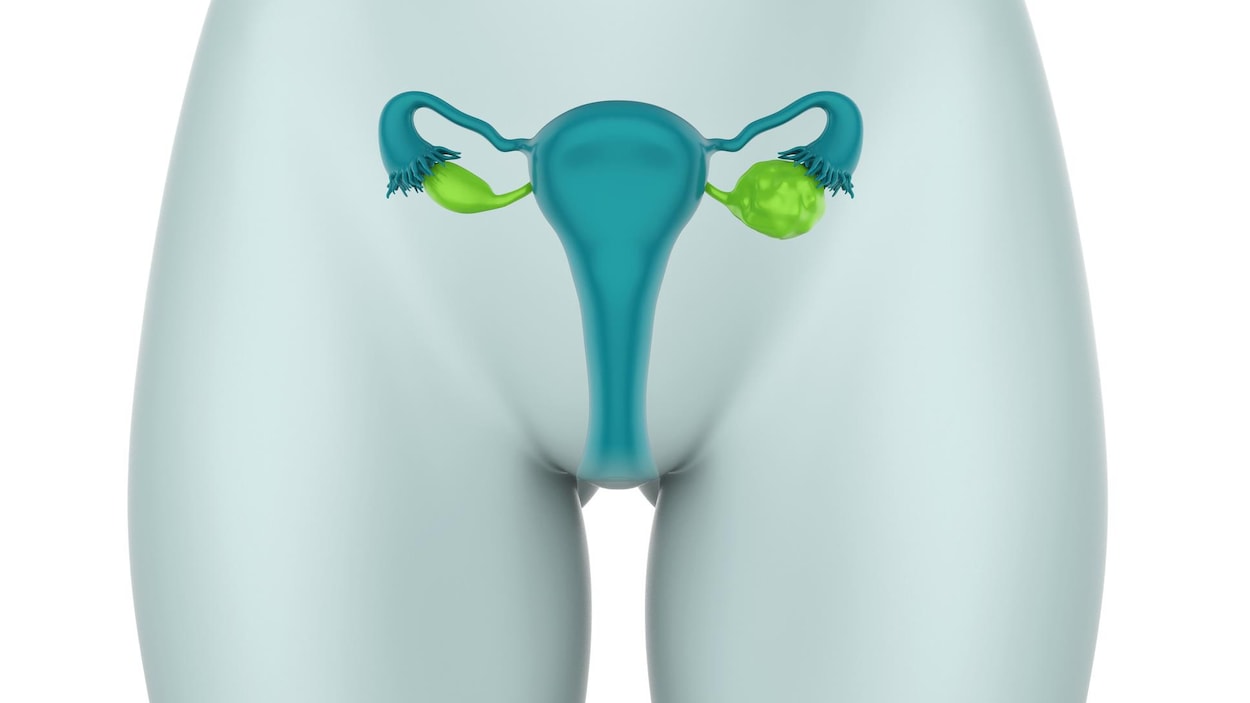 Représentation de l'appareil reproducteur de la femme. Les ovaires sont mis en évidence. Celui à droite, touché par des kystes, est plus gros.