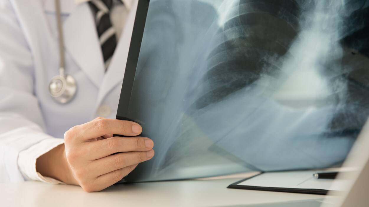Un radiologue examine une radiographie pulmonaire.