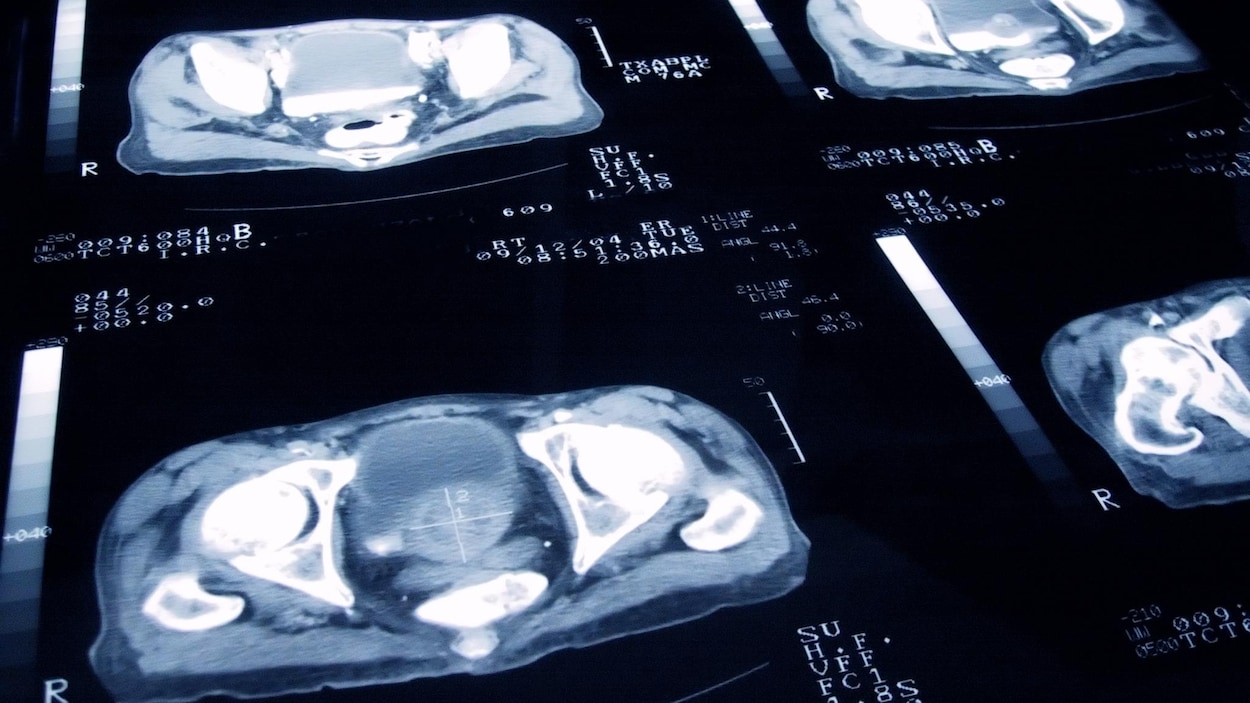 Investissement majeur pour lutter contre le cancer en Alberta