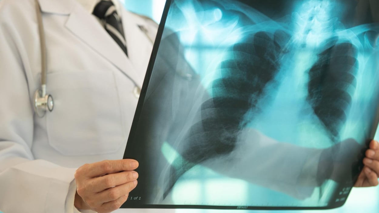 Les maladies pulmonaires en baisse à Rouyn-Noranda