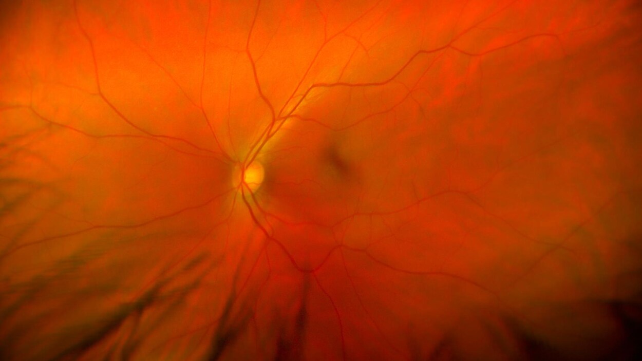 Rétine de l'oeil Rétine de l'oeil