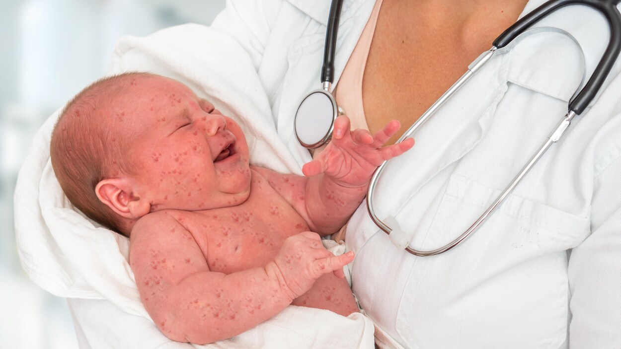 Un bébé avec des symptômes de la rougeole ou de la rubéole dans les bras d'un médecin.
