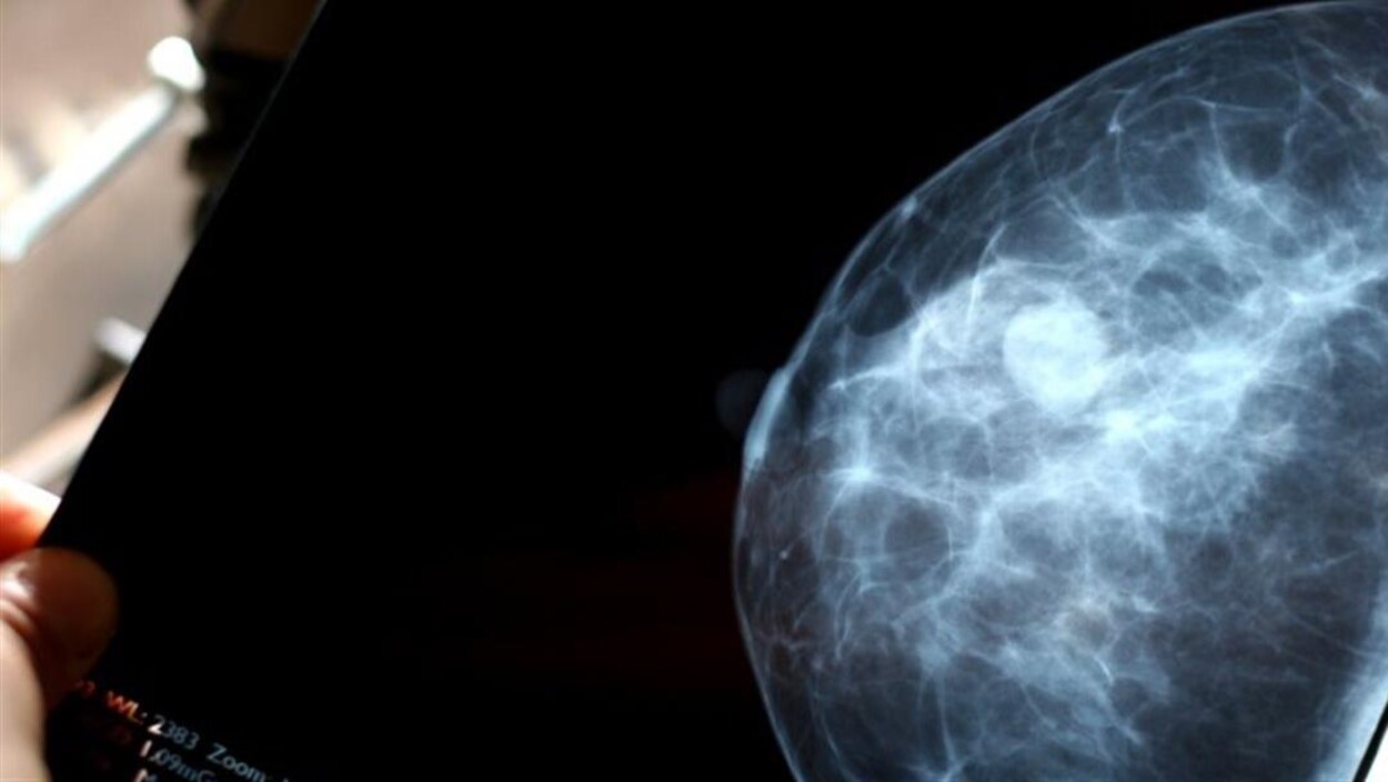 une mammographie.