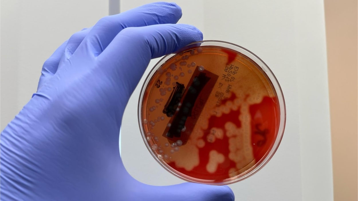 Les dangers de la bactérie streptocoque du groupe A : Attention à la bactérie mangeuse de chair !
