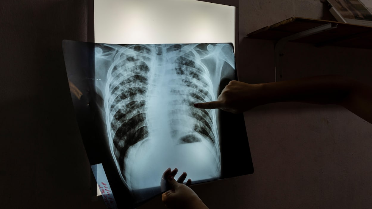 Front commun contre la tuberculose à Uashat