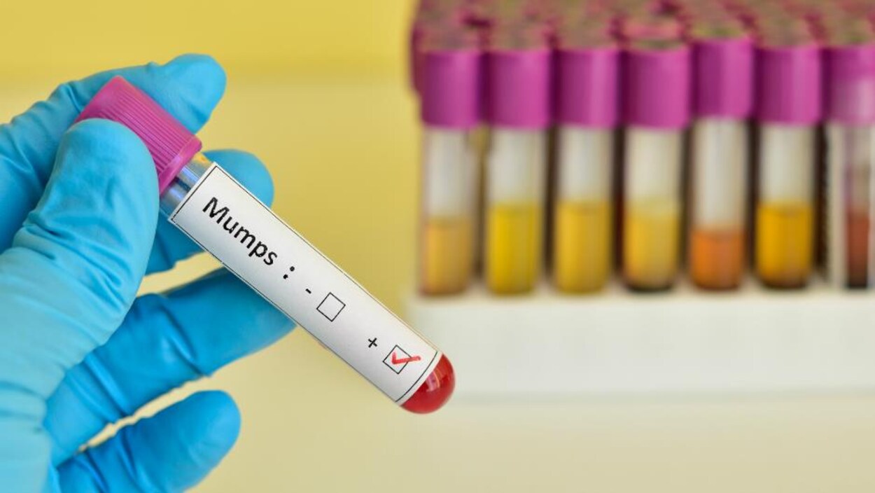 Une main enveloppée d'un gant de latex bleu tient un vaccin contre les oreillons.