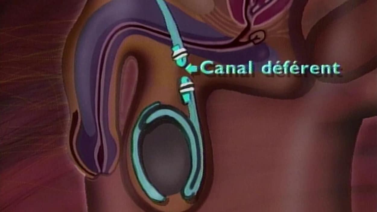 Dessin illustrant le processus de vasectomie avec la séparation du canal déférent.
