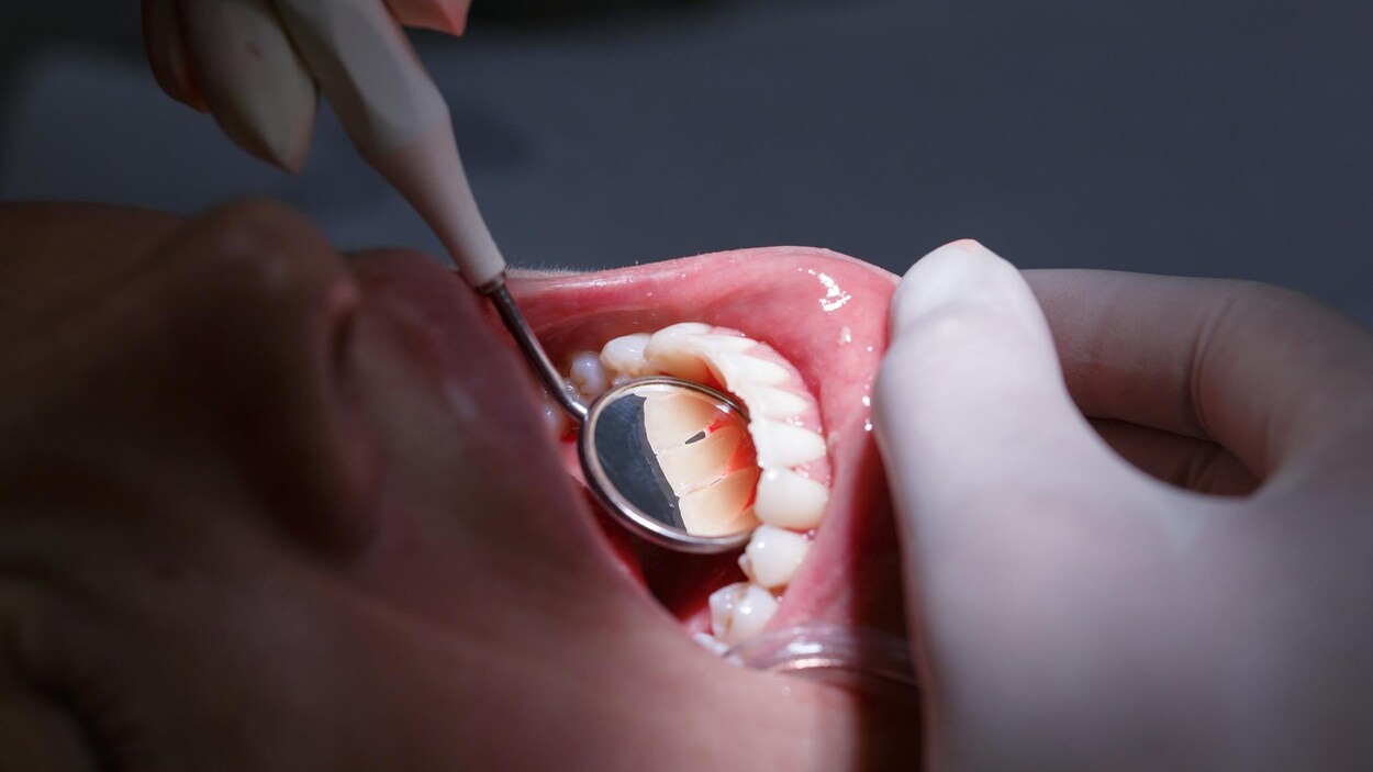 Gros plan d'une bouche ouverte avec miroir chez le dentiste.