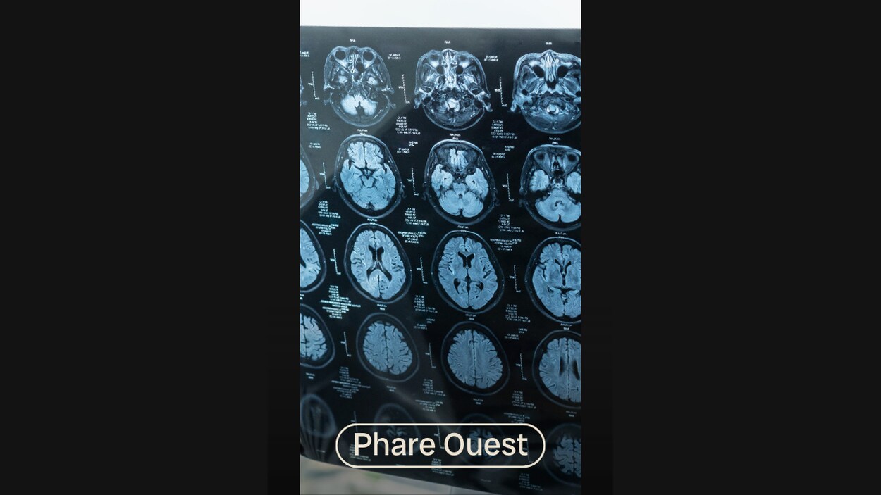 Un 2e traitement approuvé pour l'Alzheimer léger