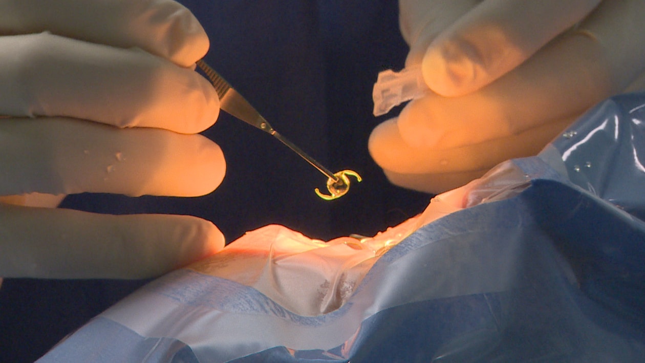 Gros plan sur les mains d'un chirurgien effectuant une opération de la cataracte.
