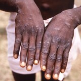 During an outbreak of monkeypox in the Democratic Republic of the Congo, a young man shows his hands, which have the characteristic rash of monkeypox during the recuperative stage. (CDC)