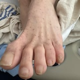 A foot with a rash.