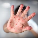 麻疹患者的手。