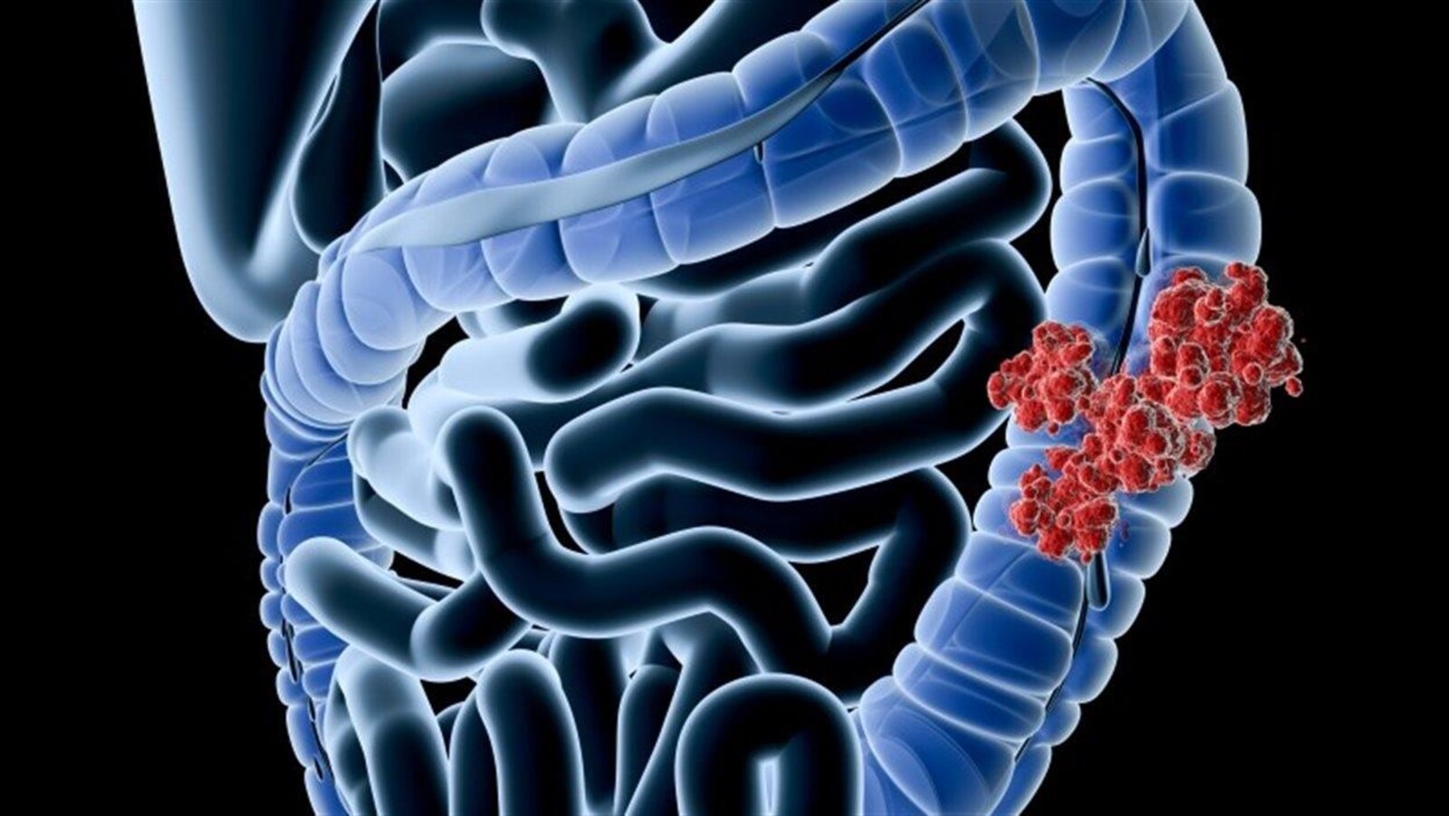 Représentation d'un cancer colorectal Photo : iStockphoto