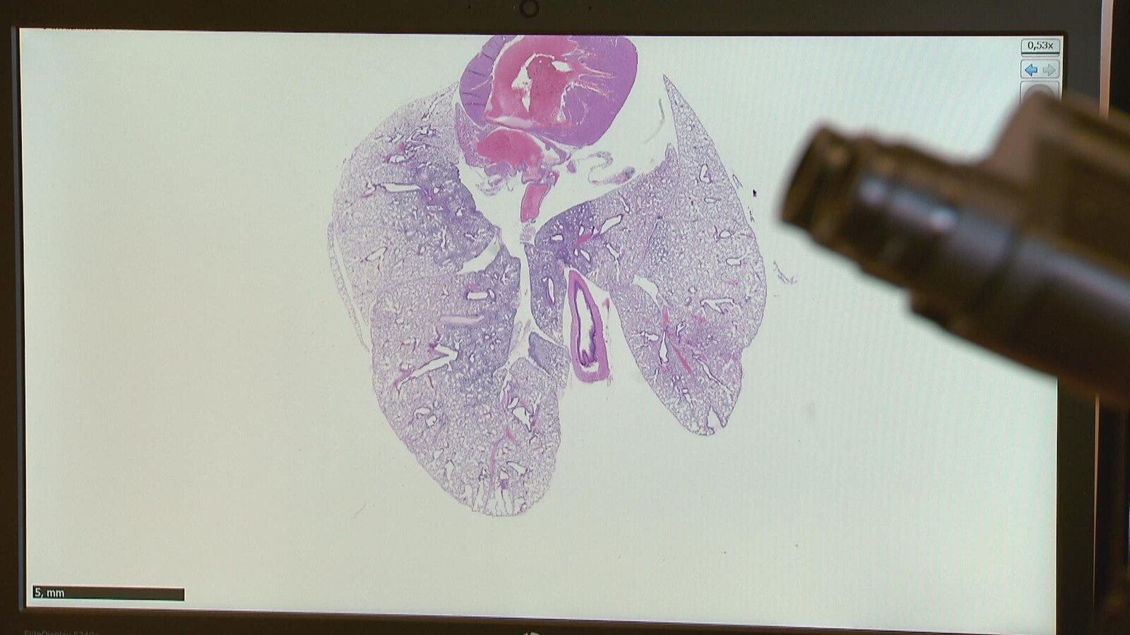 Le cancer du poumon tue près de 20 000 Canadiens chaque année