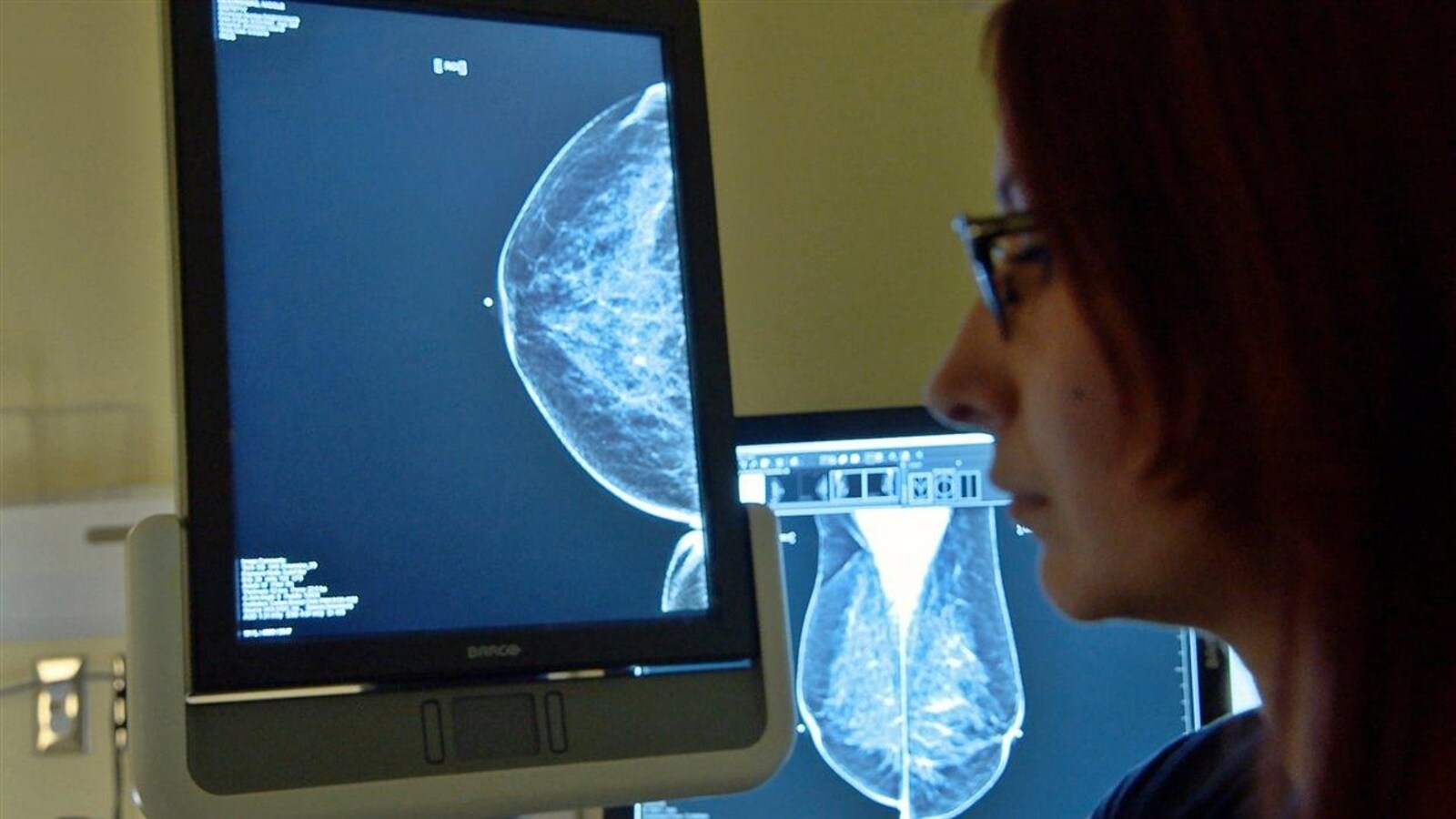 L'image d'une mammographie sur un écran