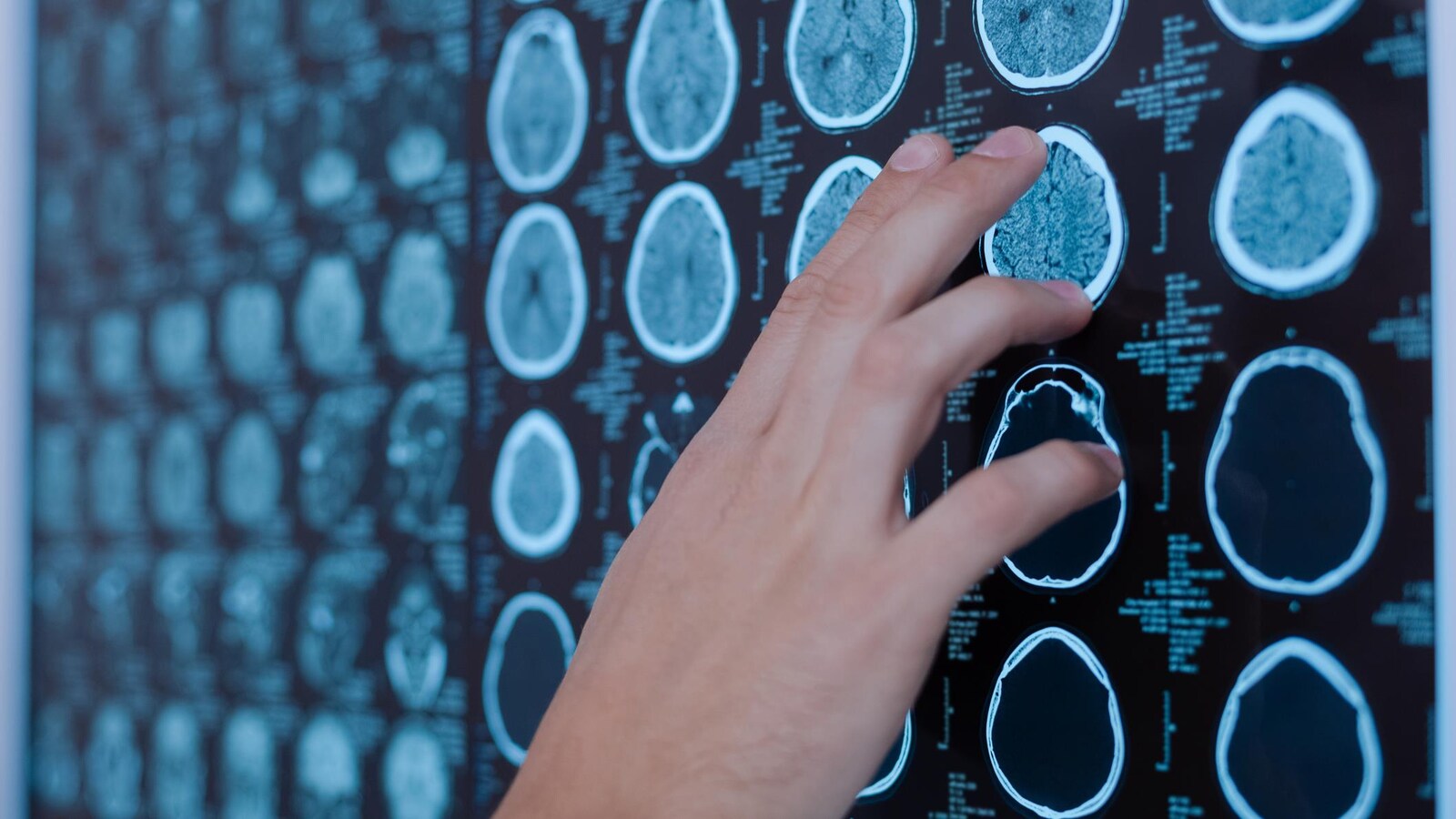 Un docteur pointe une image de cerveau.