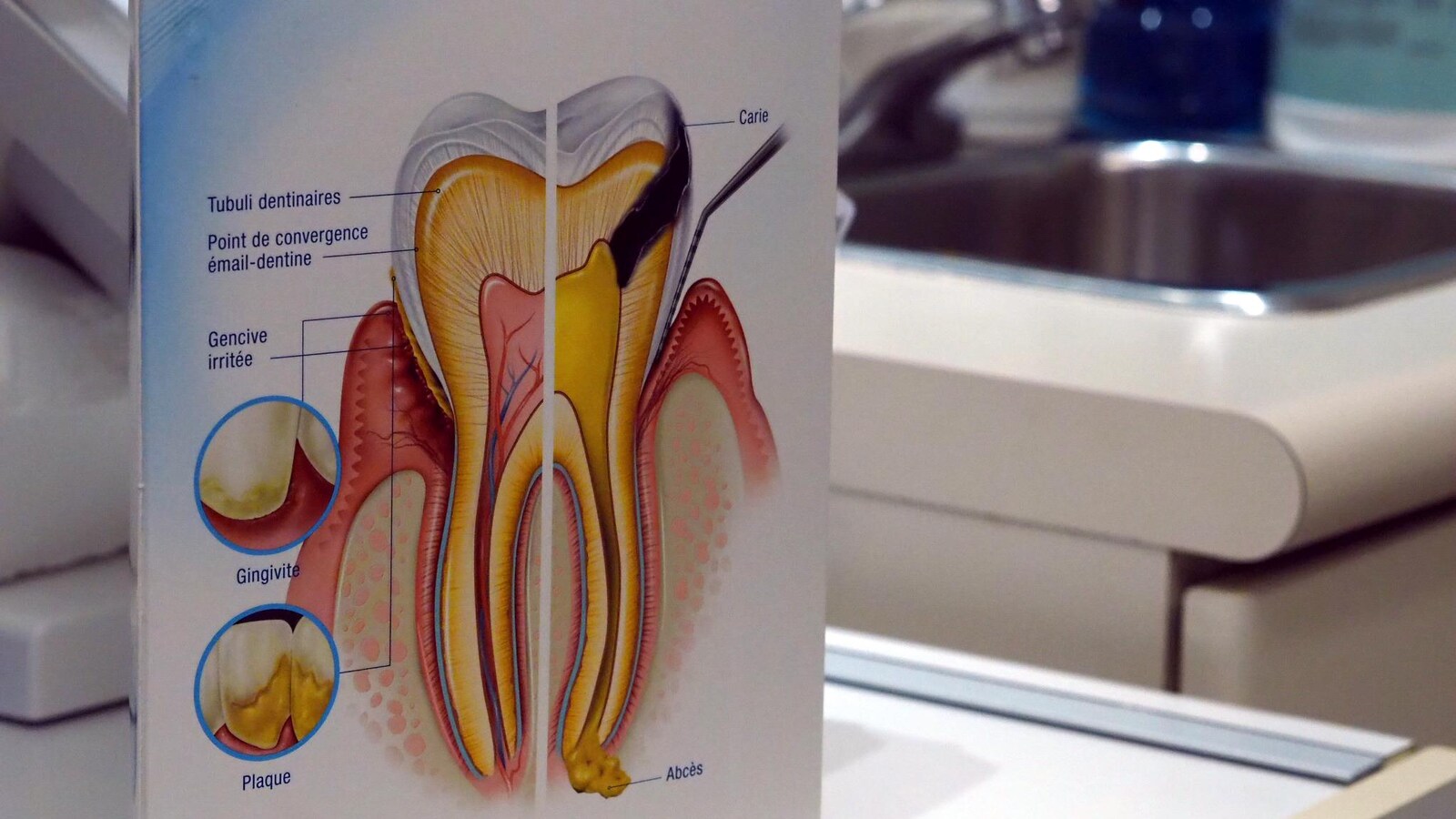 Un dessin représentant une dent malade est affiché dans un cabinet de dentiste.
